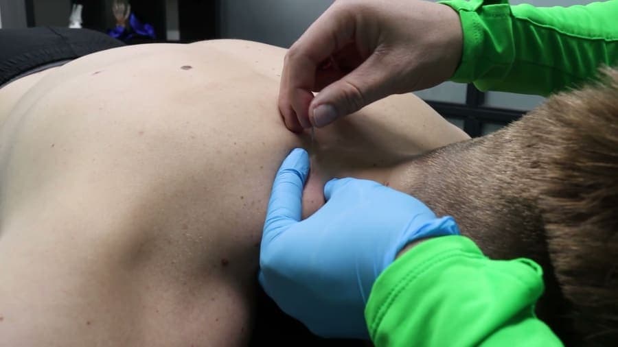 Dry needling